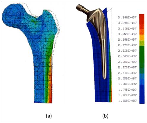 Biomechanical comparison of different prosthetic materials and posterior  implant angles in all-on-4 treatment concept by three-dimensional finite  element analysis
